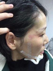 Shu Qiong injuries