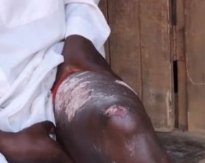 Yusufu Mwanje's injuries