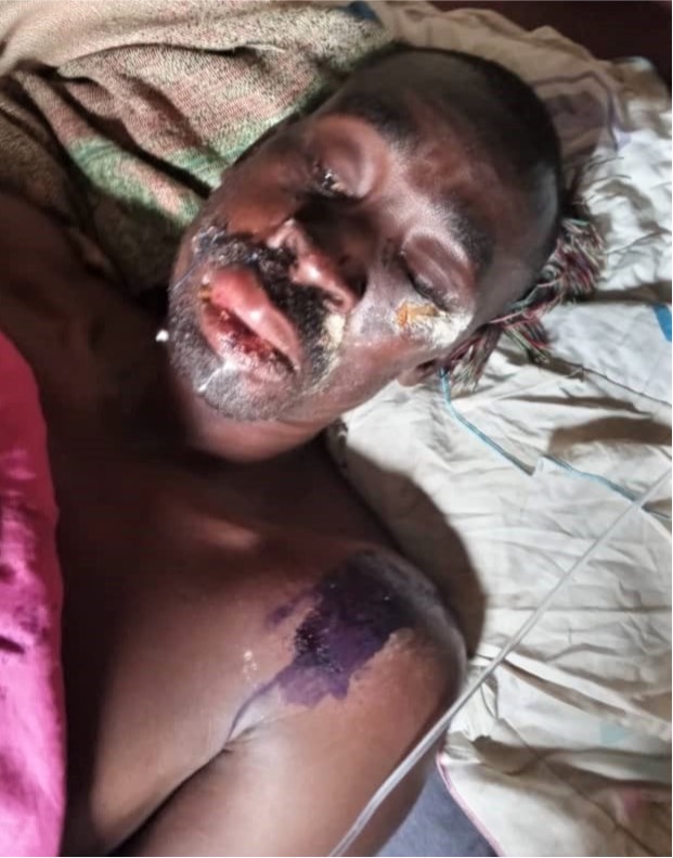 UGANDA: Pastor sprayed with acid